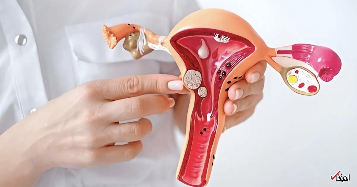 نقش فشار خون، ویتامین D و سبک زندگی در افزایش خطر فیبروم رحم