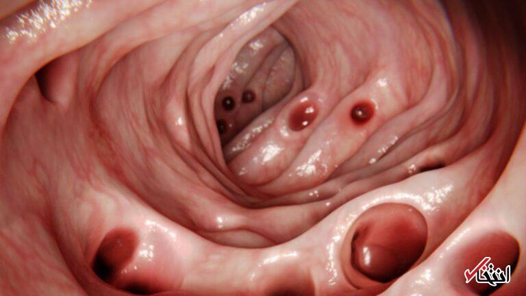 بیشتر مردم تا ۸۰سالگی دچار دیورتیکولوز روده می‌شوند اما این عارضه دقیقاً چیست؟